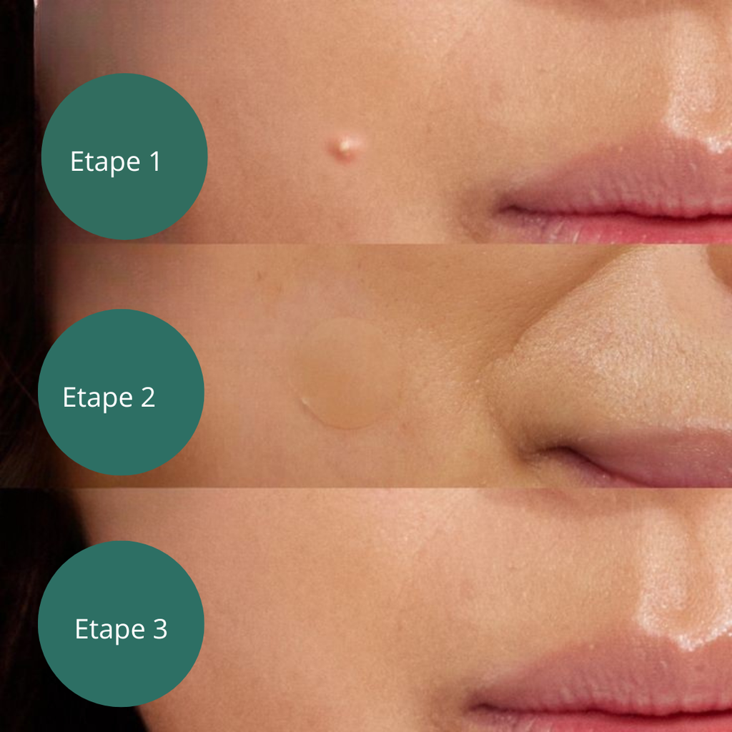 Bye Blemish patchs - 24 patchs micros-aiguilles